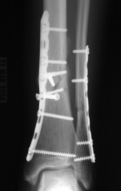Tibia, Shaft:  Synthes Distal Tibial Plate (Implant 274)